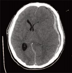 Computed Tomography Or CT Scans Neuroradiology Images In Brain Injury Cases Denver, Colorado.