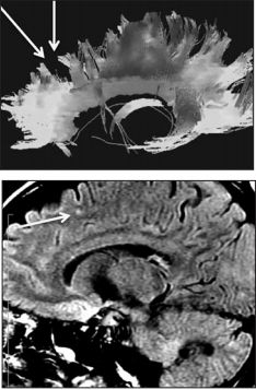 Diffusion Tensor Imaging Or DTI Denver, Colorado.