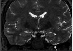 Magnetic Resonance Imaging Or MRI Denver, Colorado.