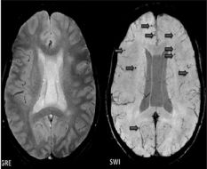 Susceptibility Weighted Imaging Or SWI And Gradient Echo Or GRE Brain Injury Denver, Colorado.