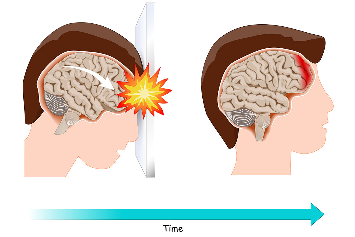 Traumatic Brain Injury With No Symptoms.